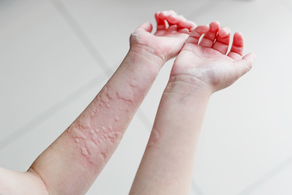 histamine intolerance